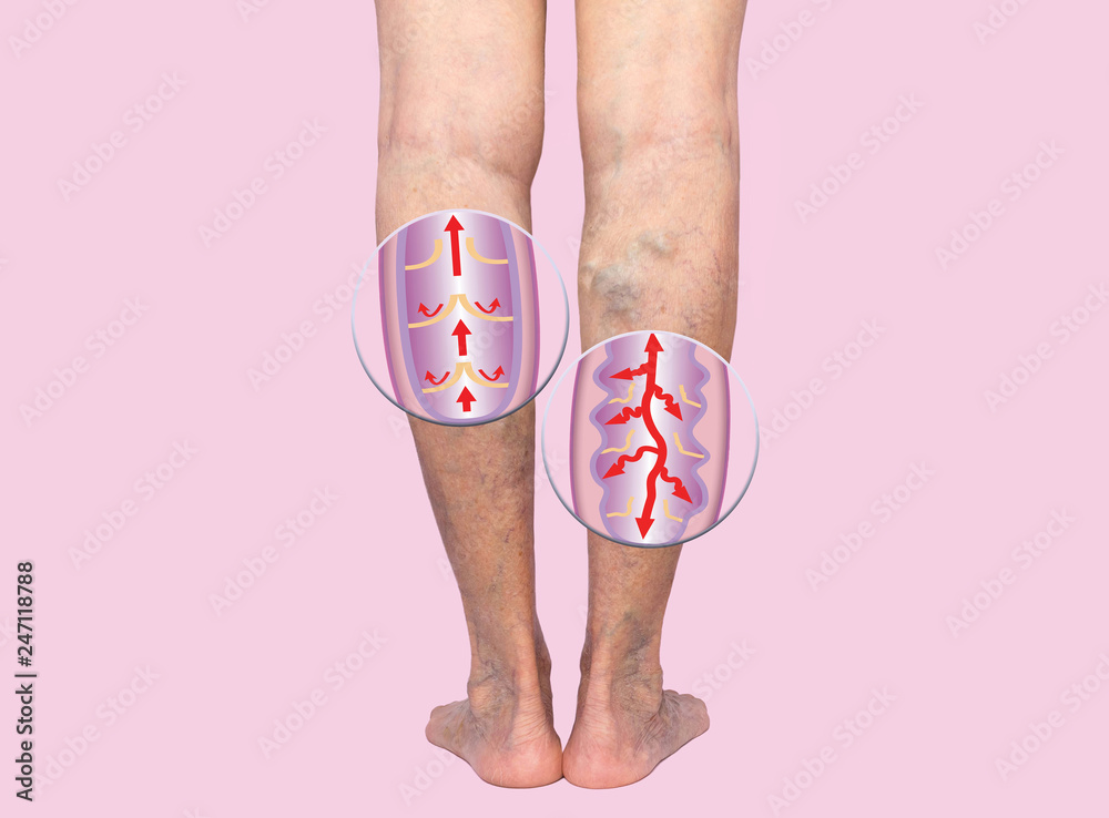 Wall mural Varicose veins on a female senior legs. The structure of normal and varicose veins.