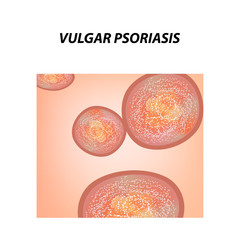 Vulgar psoriasis. Not pustular type of psoriasis. Eczema, skin disease dermatitis. Infographics. Vector illustration on isolated background.