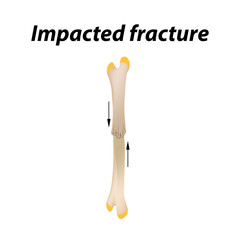 Impacted fracture Bone. Infographics. Vector illustration on a lined background.