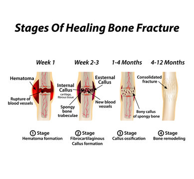 Stages Of Healing Bone Fracture. Formation of callus. The bone fracture. Infographics. Vector illustration on isolated background.