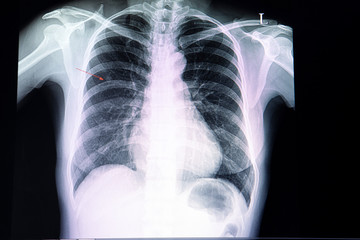 small nodule  in the lung