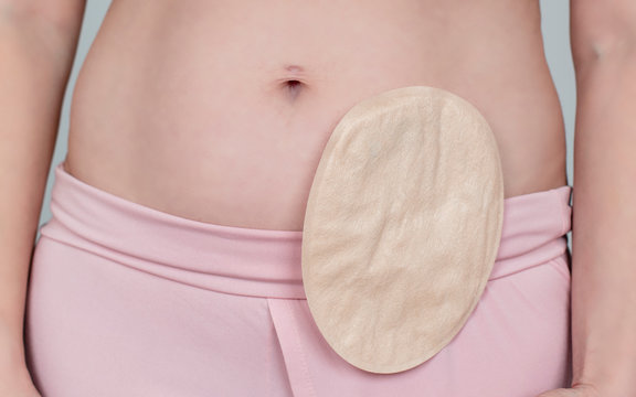 colostomy pouch attached to patient - image