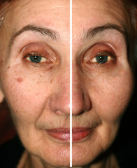 Pigmentation on the face. Brown spots and wrinkles on the skin of the face. Nasolabial folds. One...