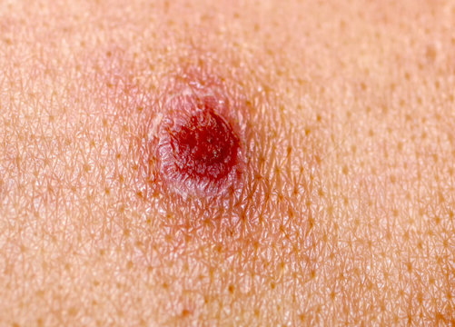 Ulcer on the skin. Smallpox. A wound, an abrasion, a cut, a scab. Chickenpox.