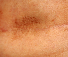 Scar on the breast after surgery. Brown spot