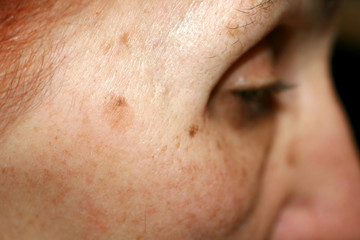 Pigmentation on the face. Brown spot on cheek. Pigment spot on the skin. Profile.