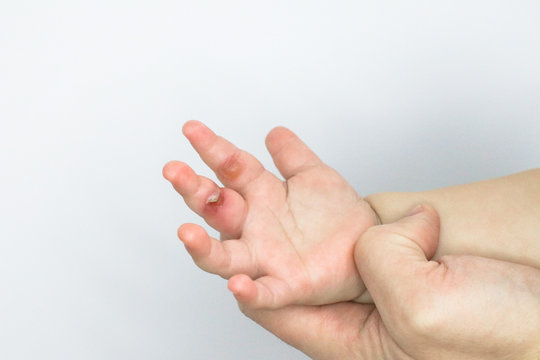 wound burn on child's hand