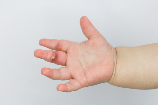 wound burn on child's hand