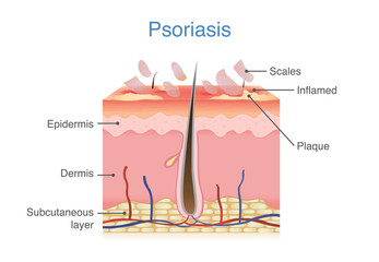 Illustration of human skin layer when plaque psoriasis signs and symptoms appear.