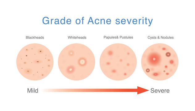 Grade of acne severity. Medical diagram about skin problems from different types acne.