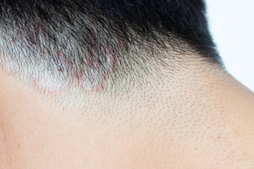 Closed up of ringworm (tinea) on head of asian man (Dermatitis)