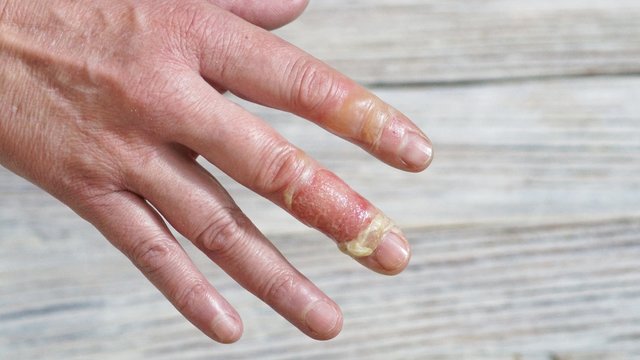 woman with a burn of the skin and fingers, injuries with boiling water, an accident at home, careless behavior with boiling water, steam, scales on the skin, an injured hand, injured fingers of a