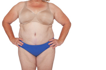 Fototapeta na wymiar Menopausal woman with weight gain after brachioplasty, panniculectomy, abdominoplasty and mummy makeover. Full body front view hands on hips, copy space right. Makeover inspiration, faded scars.