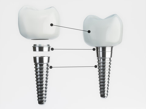 Zahnimplantat Aufbau - 3D Rendering