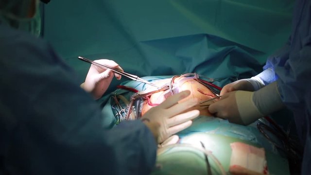 Team of cardiovascular surgery doctor in surgery center for interventions with instruments in surgeon operation with thoracotomy microsurgery doing minimal invasive open heart surgery