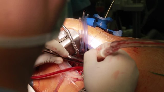 Closeup of surgeon hands doing minithoracotomy open heart surgery with surgeon in surgery center for interventions with with clamps, forceps in operation electrosurgery with microsurgery