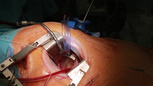 Closeup of surgeon hands doing minithoracotomy live beating open heart surgery in operation room