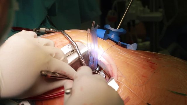 Closeup of minithoracotomy surgery with surgeon in surgery center for interventions with with clamps, forceps in operation electrosurgery with microsurgery doing minimal invasive open heart surgery
