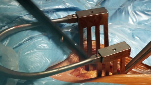 Close up of open heart surgery cardiopulmonary bypass, minimal invasive cardiac surgery, cannulation techniques. Minimally invasive mitral surgery through mini-thoracotomy with cannula