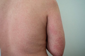 An exanthem is a rash or eruption on the skin. 