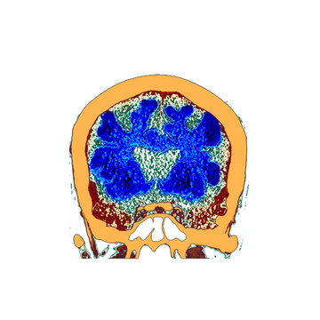 Brain in dementia, CT scan