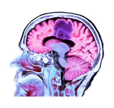 Glioblastoma brain cancer, CT scan
