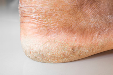 Cracked skin on heels. Dry skin of the feet.