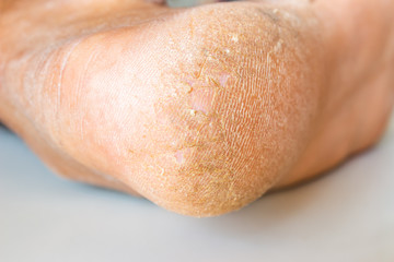 Fototapeta premium Cracked skin on heels. Dry skin of the feet.