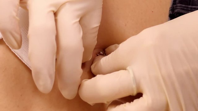 slow motion closeup piercing master in gloves puts gold sparkling belly button ring into navel fistula 