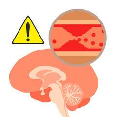 脳梗塞の危険