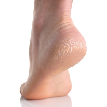 The Heel Of Foot With Bad Skin Covered With Cracks