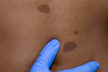 Medical dermatologist examines benign moles in African patient.