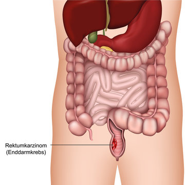 Rektumkarzinom Enddarmkrebs Vektor Illustration