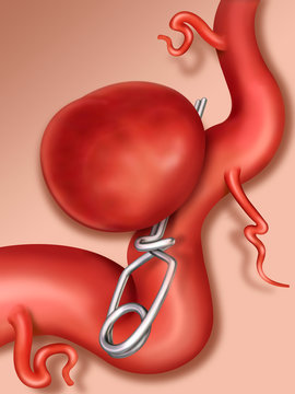 Recorte de aneurisma Ilustraci&oacute;n 
