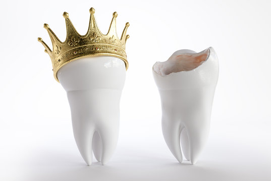 Tooth with a crown - 3D Rendering