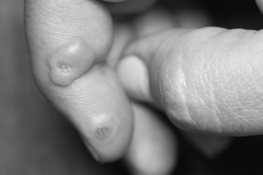 Macro image of huge ugly blisters after applying cryodestruction treatment to hpv warts on skin of female fingers. Horizontal black and white photography.
