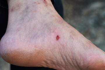 Fototapeta premium A lot of scar on old woman feet. The cracks at the heel.