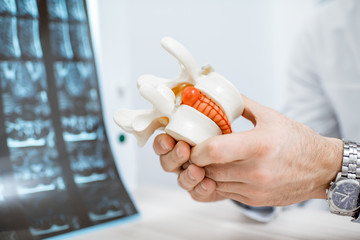 Close-up of therapist holding anatomical model of vertebras with intervertebral hernia - obrazy, fototapety, plakaty