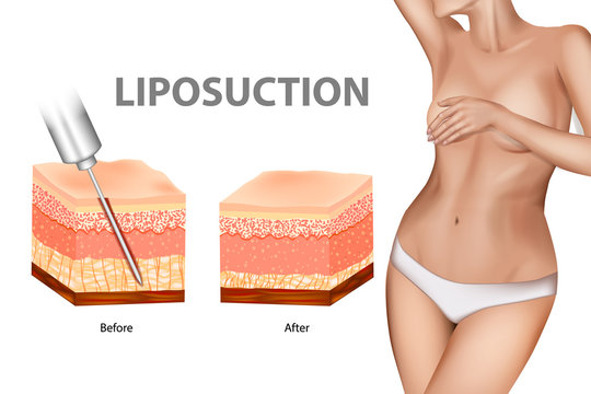 Liposuction or lipo. The Human Skin layer before lipo and after Liposuction. Plastic surgery infographic of Aesthetic Procedures
