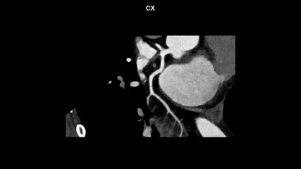 Left circumflex artery is an artery(LCX) branches curve with computed tomography angiography, CTA...