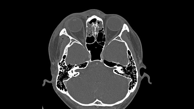 CT X-ray Scan on Human Brain fracture orbit.