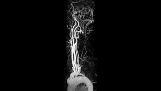 MRA Brain (Magnetic Resonance Angiography)of the blood vessels in the brain and cerebrovascular disease. brain stroke x-ray image