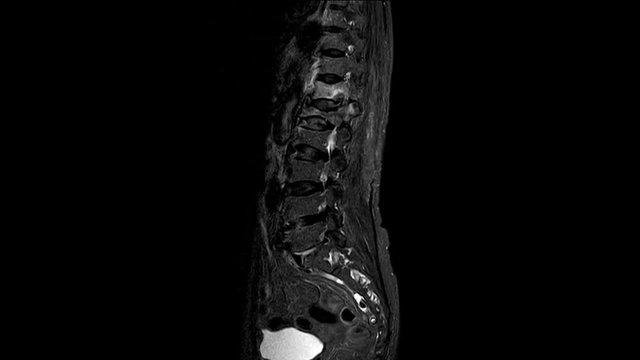 MRI OF THE LUMBOSACRAL SPINE The findings are probably TB spine as Marked reduction in height of L1 and L2 vertebral bodies, showing abnormal outline.