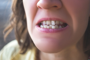 Photo of crooked woman teeth