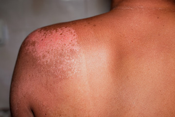man with reddened, itchy skin after sunburn.