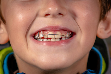 A kid smiles while showing an orthodontics corrective apparatus