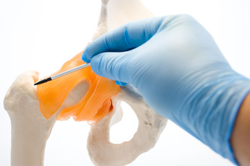 Fracture of femoral neck concept photo. Orthopedist points with pointer at neck of femur bone as...