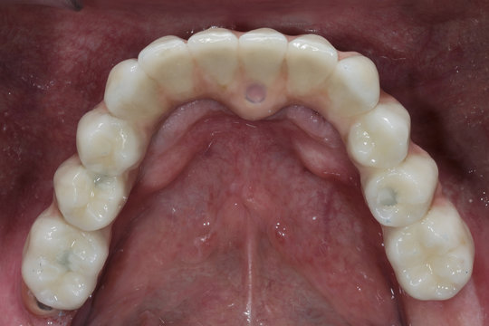 intraoral photography ceramics mandibular prosthesis