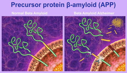 Proteína beta-amiloide y la enfermedad de Alzheimer - obrazy, fototapety, plakaty