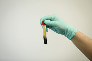 Details with the hand of a doctor holding a vial of blood plasma extracted from blood by centrifugation
